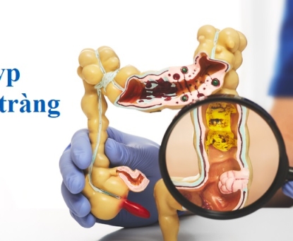 Nguyên nhân gây ra polyp đại tràng là gì?